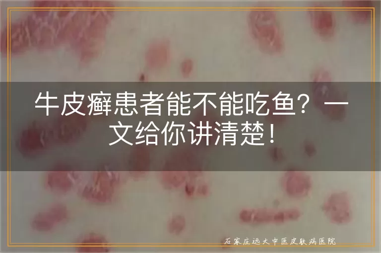 牛皮癣患者能不能吃鱼?一文给你讲清楚!
