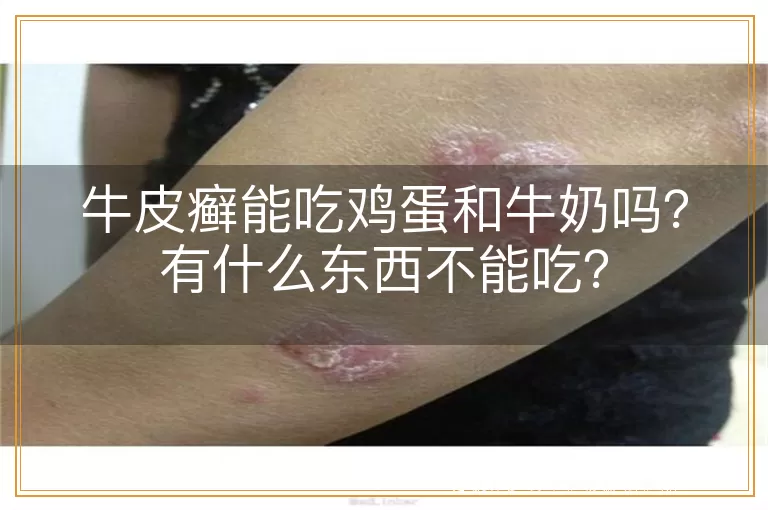 牛皮癣能吃鸡蛋和牛奶吗?有什么东西不能吃?