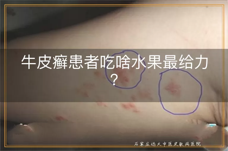 牛皮癣患者吃啥水果最给力?