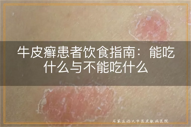 牛皮癣患者饮食指南:能吃什么与不能吃什么