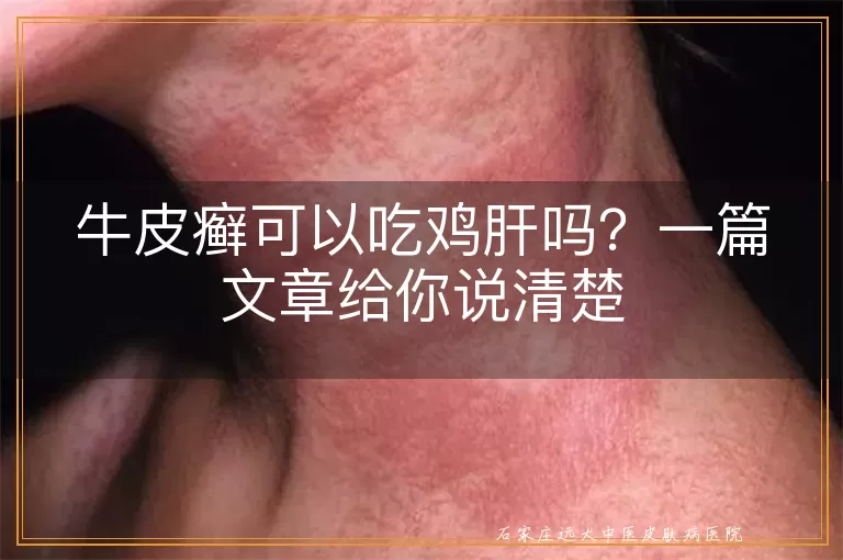 牛皮癣可以吃鸡肝吗？一篇文章给你说清楚