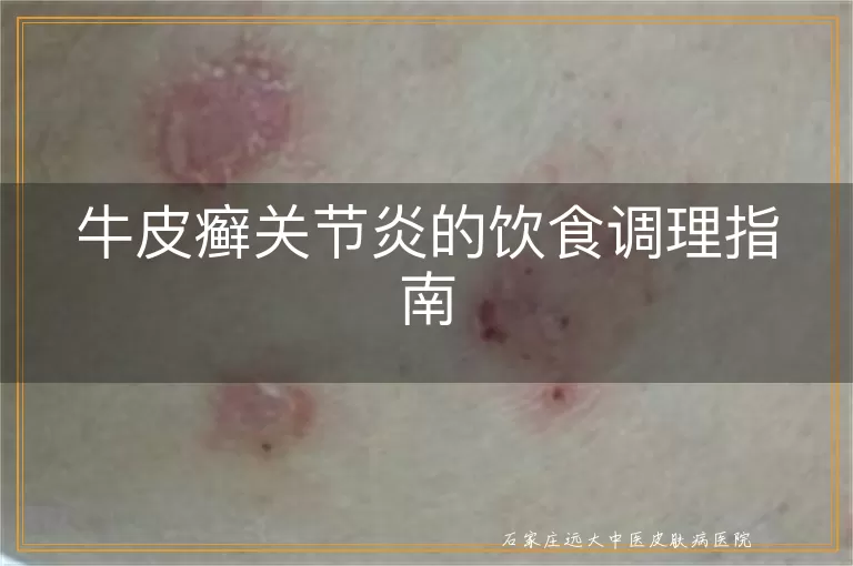 牛皮癣关节炎的饮食调理指南