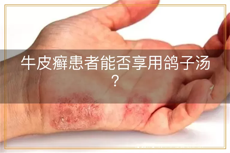 牛皮癣患者能否享用鸽子汤？