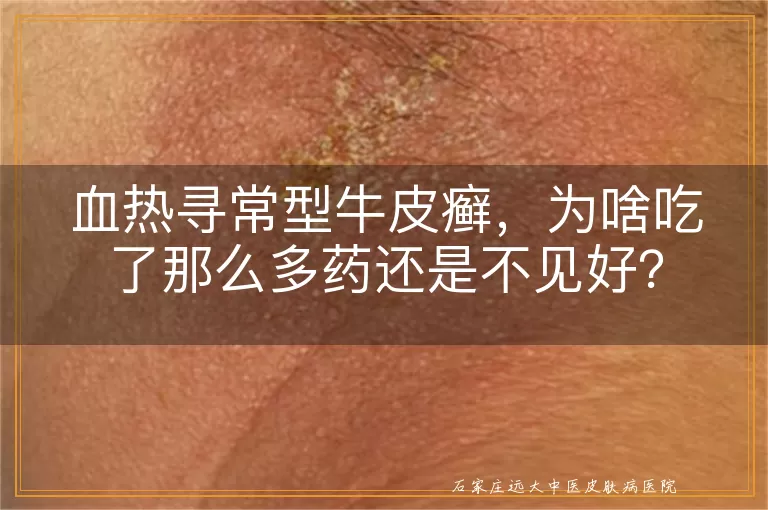 血热寻常型牛皮癣,为啥吃了那么多药还是不见好?