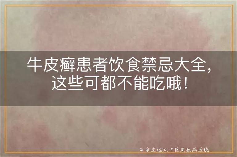 牛皮癣患者饮食禁忌大全，这些可都不能吃哦！