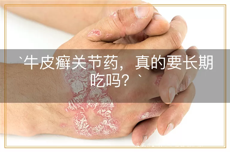 牛皮癣关节药，真的要长期吃吗？