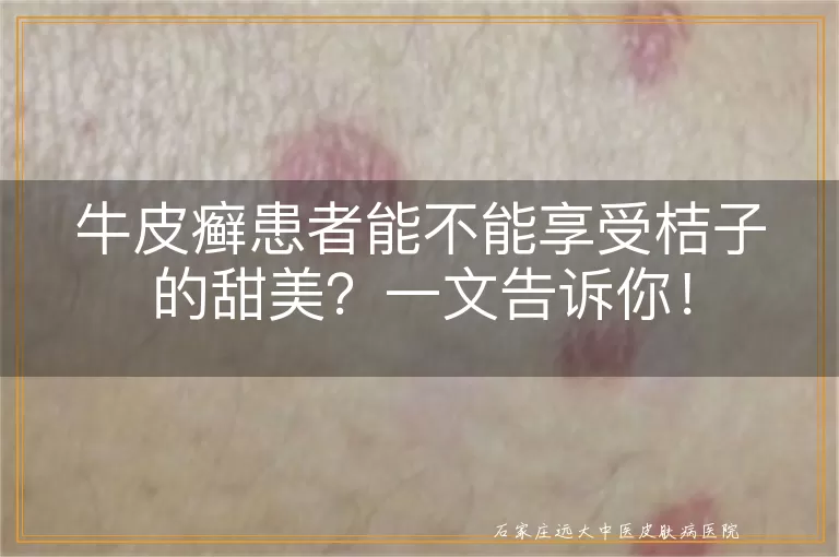 牛皮癣患者能不能享受桔子的甜美？一文告诉你！