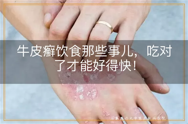 牛皮癣饮食那些事儿，吃对了才能好得快！
