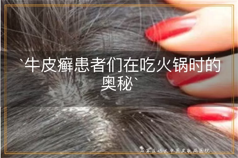 牛皮癣患者们在吃火锅时的奥秘