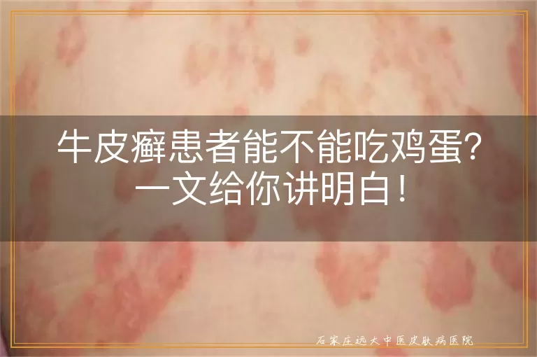 牛皮癣患者能不能吃鸡蛋?一文给你讲明白!