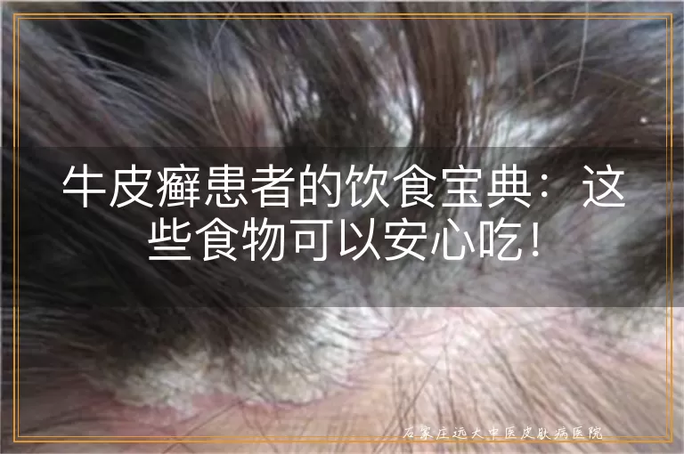 牛皮癣患者的饮食宝典：这些食物可以安心吃！