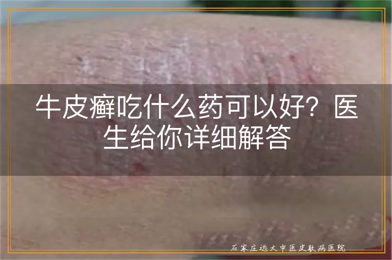 牛皮癣吃什么药可以好？医生给你详细解答