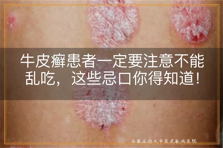 牛皮癣患者一定要注意不能乱吃，这些忌口你得知道！