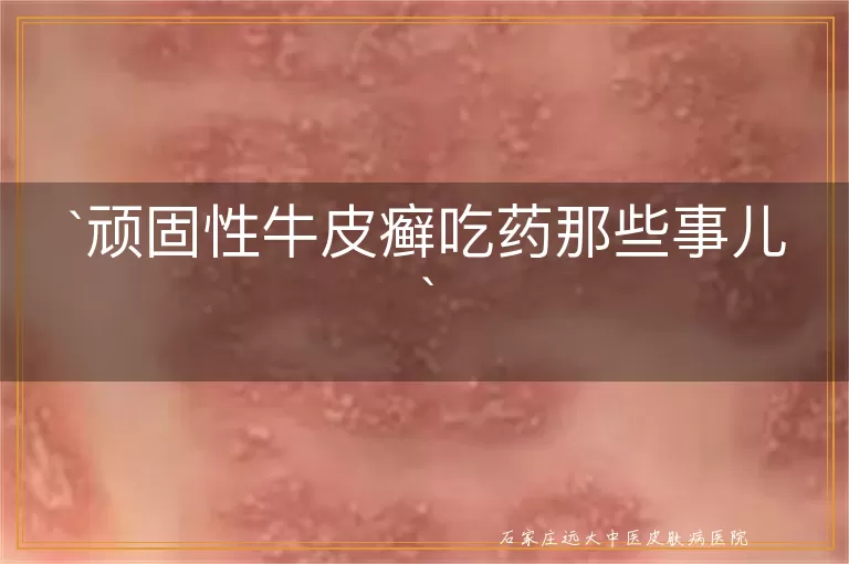 顽固性牛皮癣吃药那些事儿
