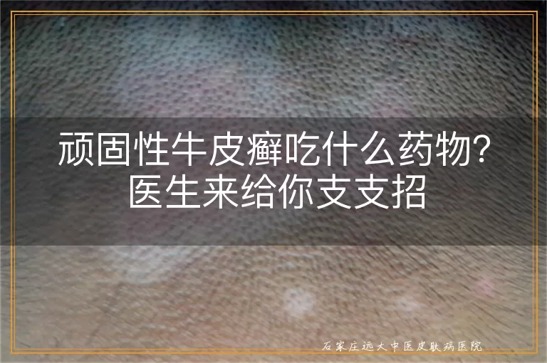 顽固性牛皮癣吃什么药物？医生来给你支支招