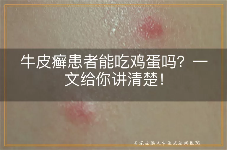 牛皮癣患者能吃鸡蛋吗？一文给你讲清楚！