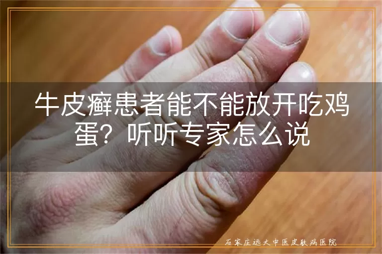 牛皮癣患者能不能放开吃鸡蛋？听听专家怎么说