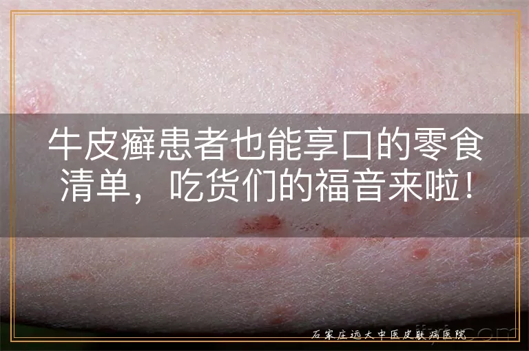 牛皮癣患者也能享口的零食清单，吃货们的福音来啦！