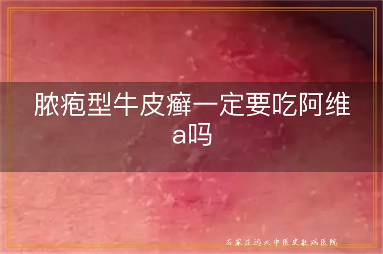 脓疱型牛皮癣一定要吃阿维a吗