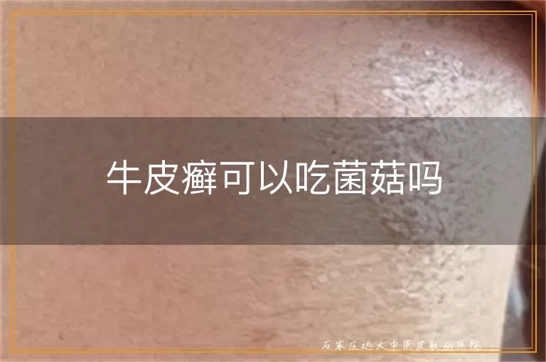 牛皮癣可以吃菌菇吗