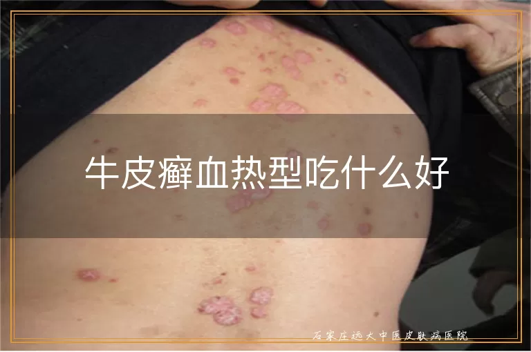 牛皮癣血热型吃什么好