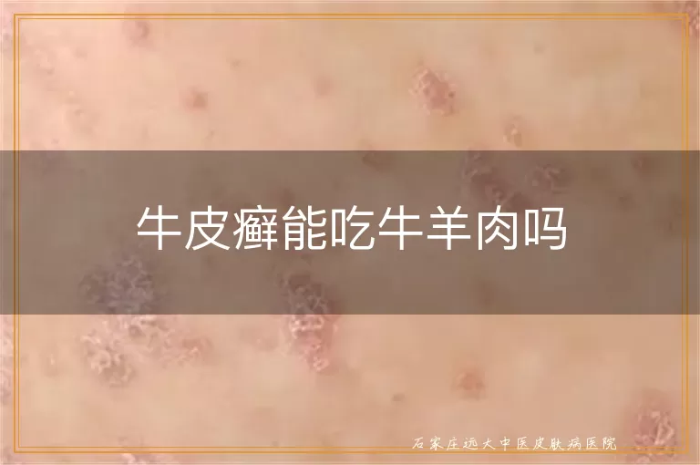 牛皮癣能吃牛羊肉吗