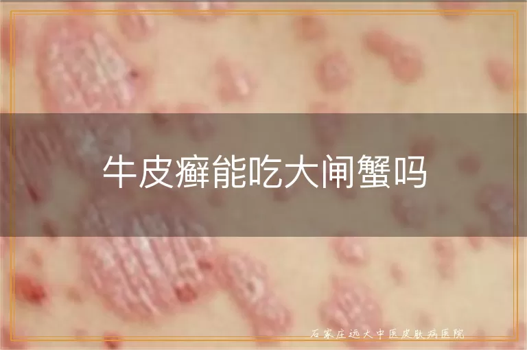 牛皮癣能吃大闸蟹吗