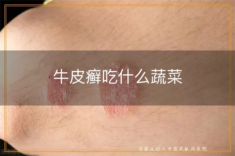 牛皮癣吃什么蔬菜