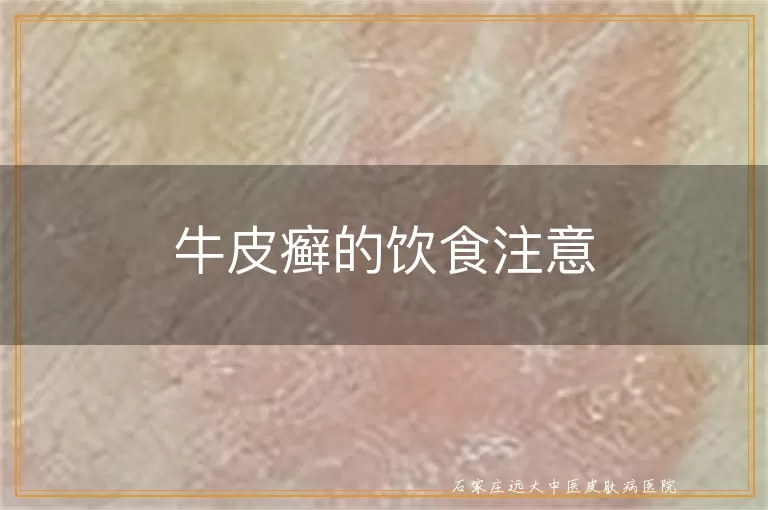 牛皮癣的饮食注意