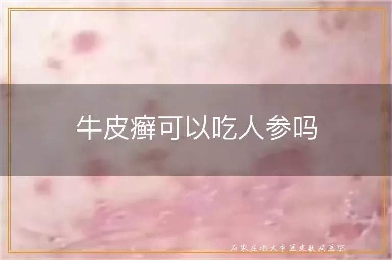 牛皮癣可以吃人参吗