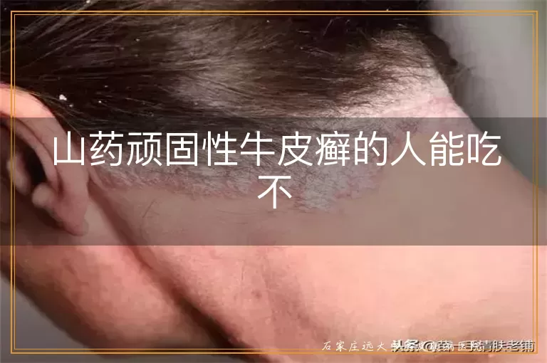 山药顽固性牛皮癣的人能吃不
