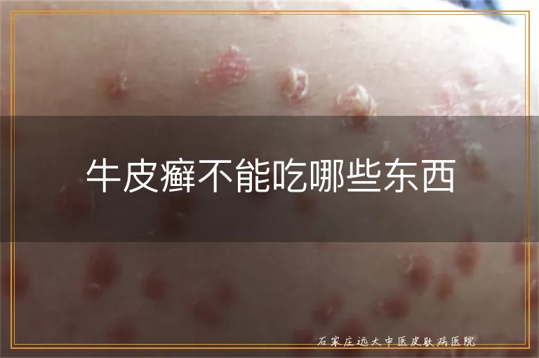牛皮癣不能吃哪些东西