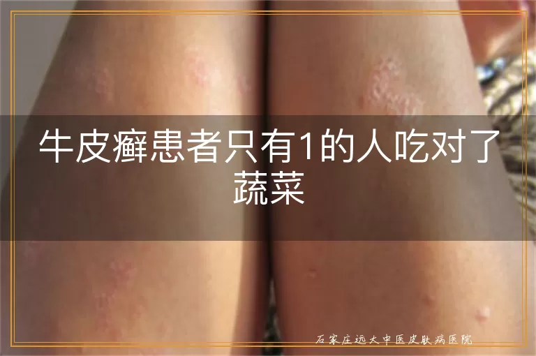 牛皮癣患者只有1的人吃对了蔬菜