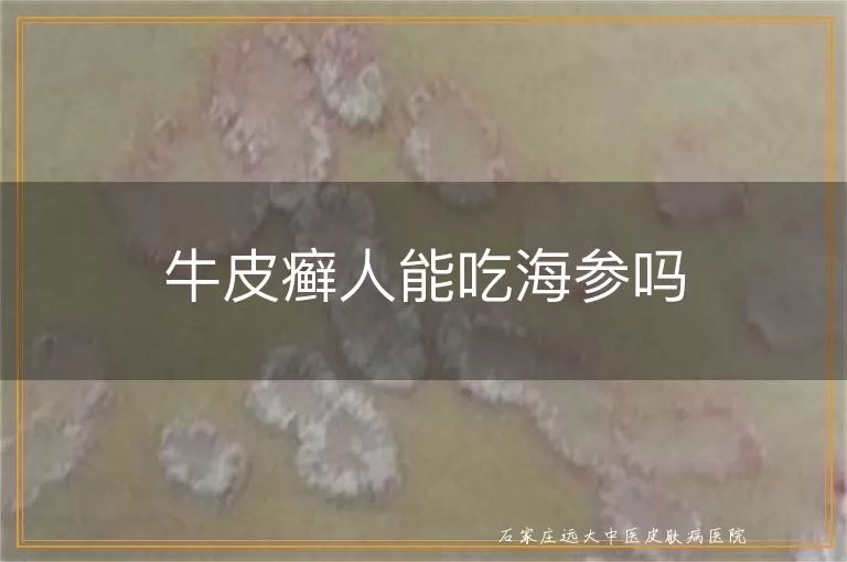 牛皮癣人能吃海参吗
