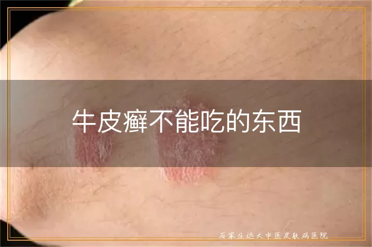 牛皮癣不能吃的东西