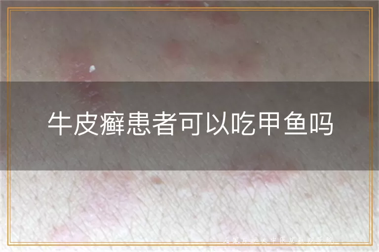 牛皮癣患者可以吃甲鱼吗