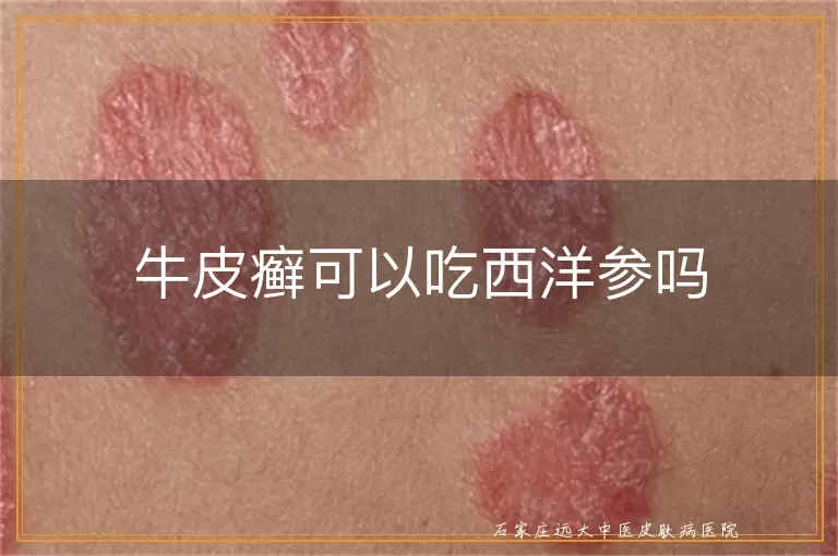 牛皮癣可以吃西洋参吗