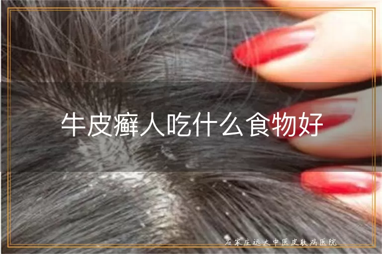牛皮癣人吃什么食物好