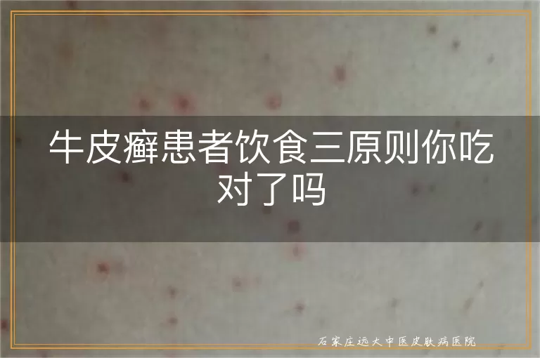 牛皮癣患者饮食三原则你吃对了吗