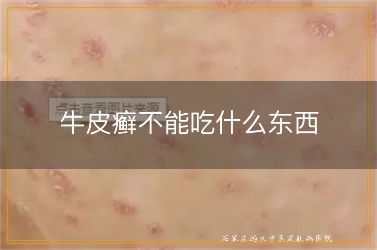 牛皮癣不能吃什么东西