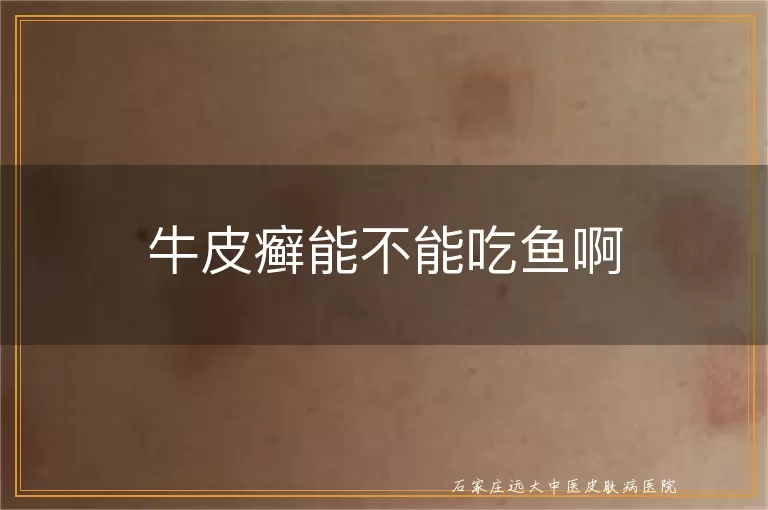 牛皮癣能不能吃鱼啊