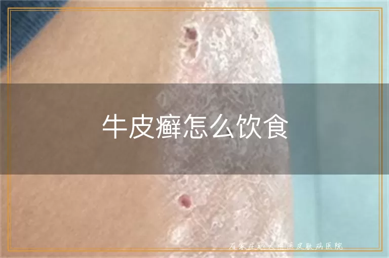 牛皮癣怎么饮食