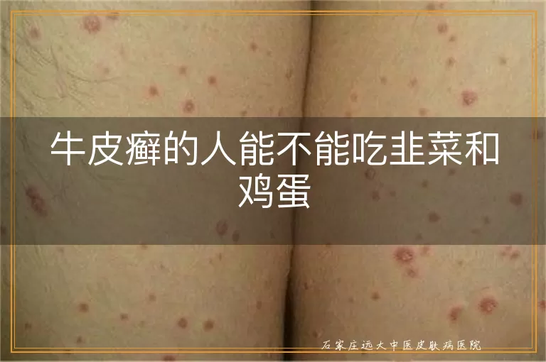 牛皮癣的人能不能吃韭菜和鸡蛋