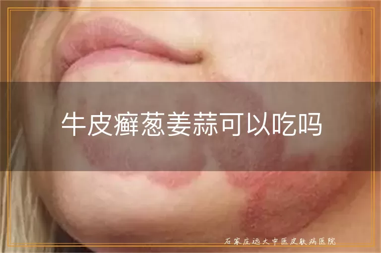 牛皮癣葱姜蒜可以吃吗
