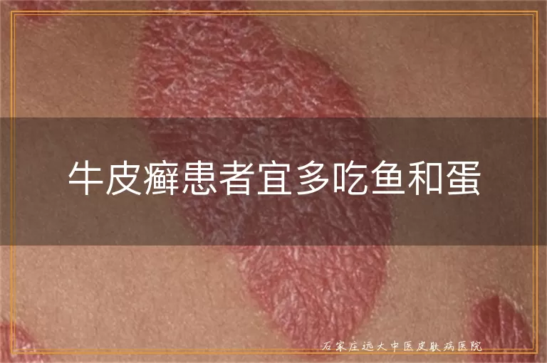牛皮癣患者宜多吃鱼和蛋