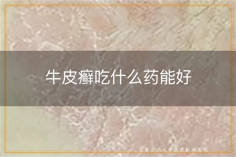 牛皮癣吃什么药能好