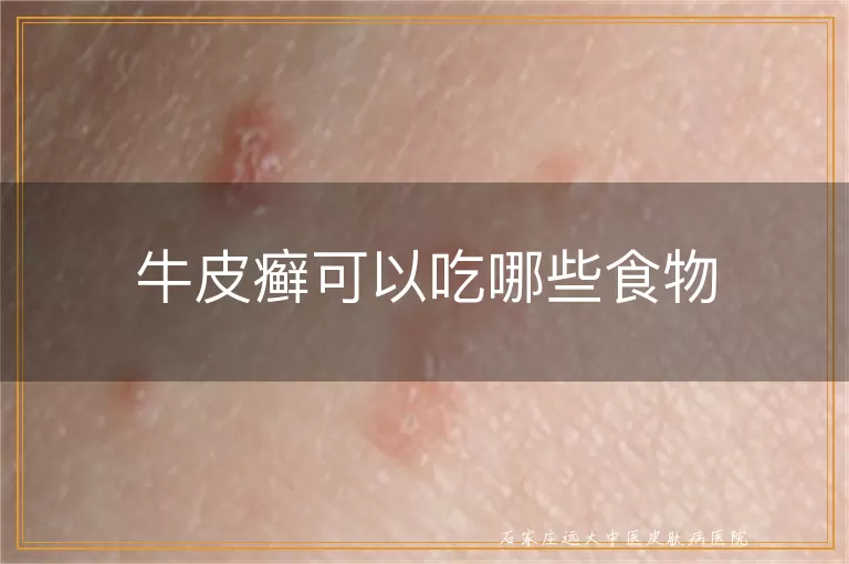 牛皮癣可以吃哪些食物