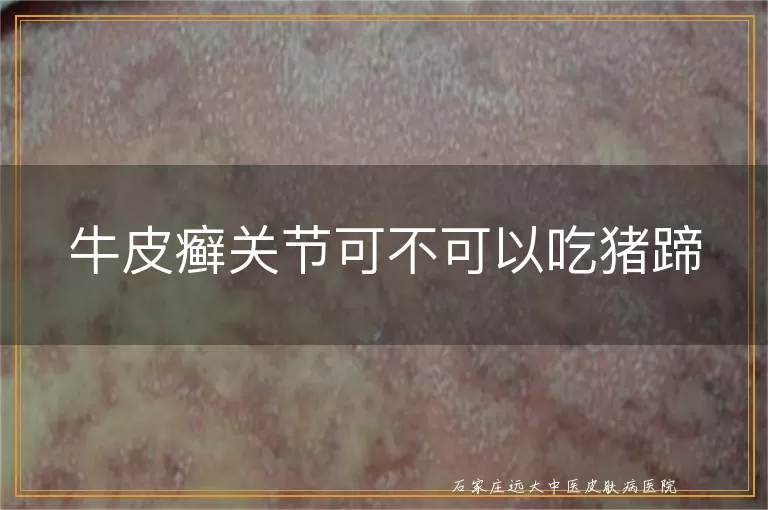牛皮癣关节可不可以吃猪蹄
