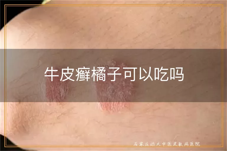牛皮癣橘子可以吃吗