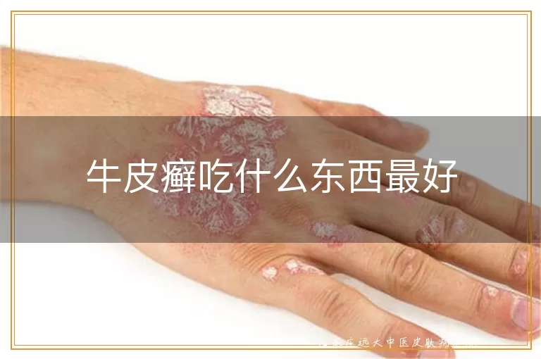 牛皮癣吃什么东西最好